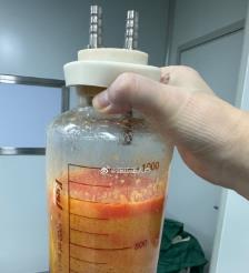 高密水动力吸脂手术要做多久？